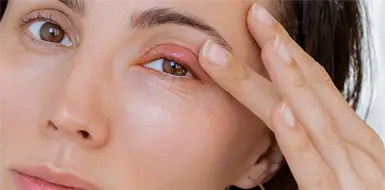 ¿Te salió una bolita en el ojo? ¿Te salió una bolita en el ojo?
