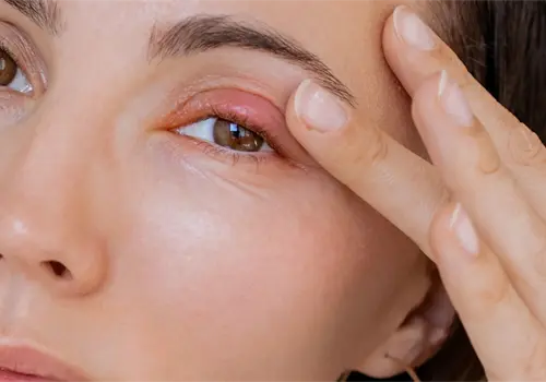 &iquest;Te sali&oacute; una bolita en el ojo?